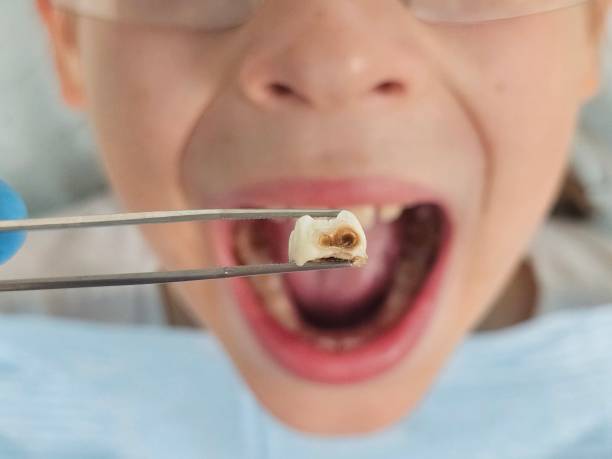 Best Emergency Dental Care for Broken or Chipped Teeth in Buhler, KS
